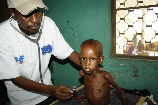 A doctor prepares four-year-old Fatuma Ibrahim for a check up at a medical camp in Somalia. Malnourished children have become the posterchild of hunger and famine in Baidoa.
