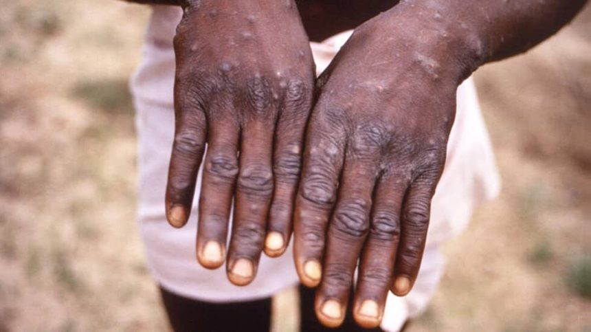 The infection is transmitted to humans through physical contact with contaminated materials, or with infected animals or other human beings.